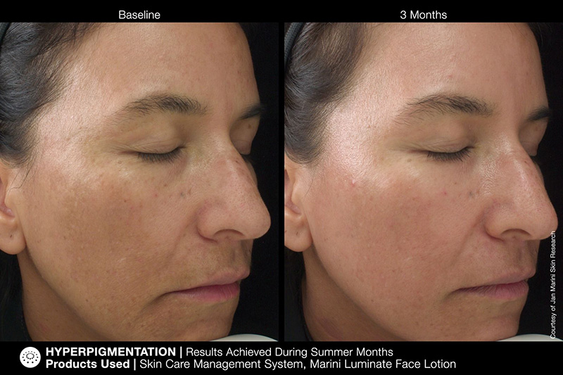 Marini SkinSolutions Luminate® Face Lotion Lotion depigmentacyjny 30 ml